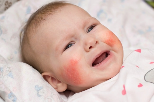 Penyebab Alergi Pada Bayi